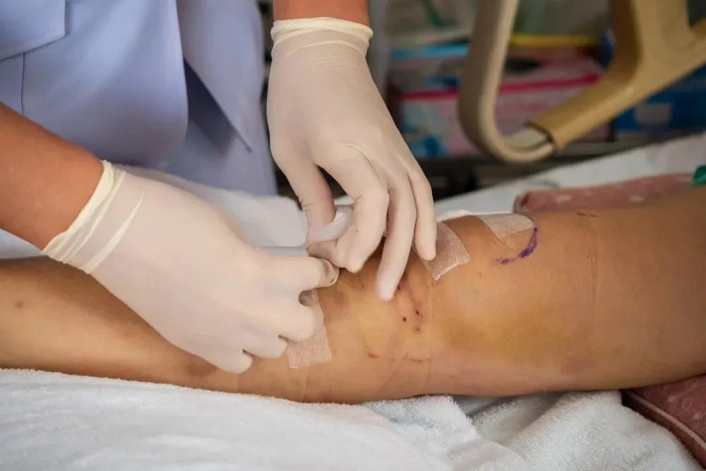 Manejo avanzado de úlceras varicosas